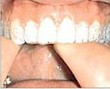 Home Tooth Whitening - Stage 2